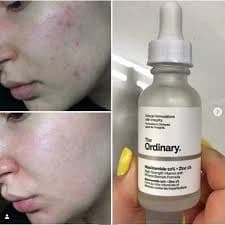 The Ordinary Niacinamide 10% + Zinc 1%, 30ml thumbnail 4