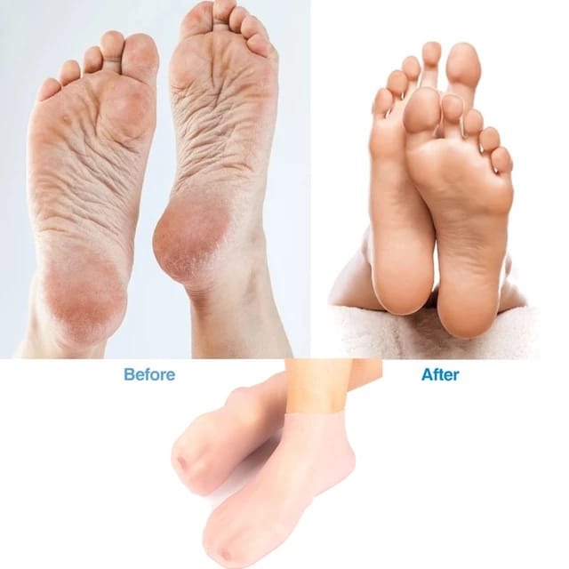 Winter Bundle Silicone Socks+Gloves